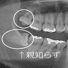 親知らずを抜かずに放置した結果 口が開かなくなってしまった ライブドアニュース