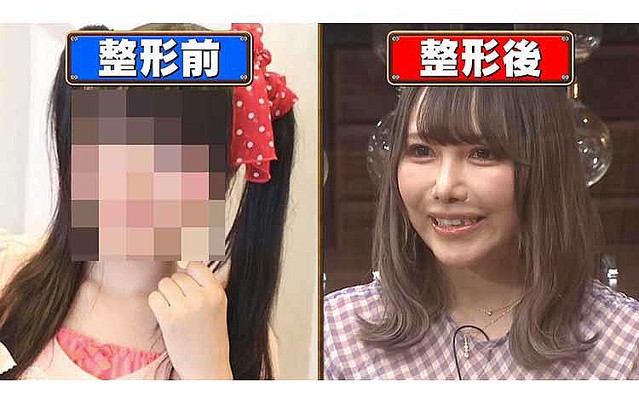 37歳にして整形にどハマリした現役アイドル 脂肪吸引後は痛みで1カ月動けず ライブドアニュース