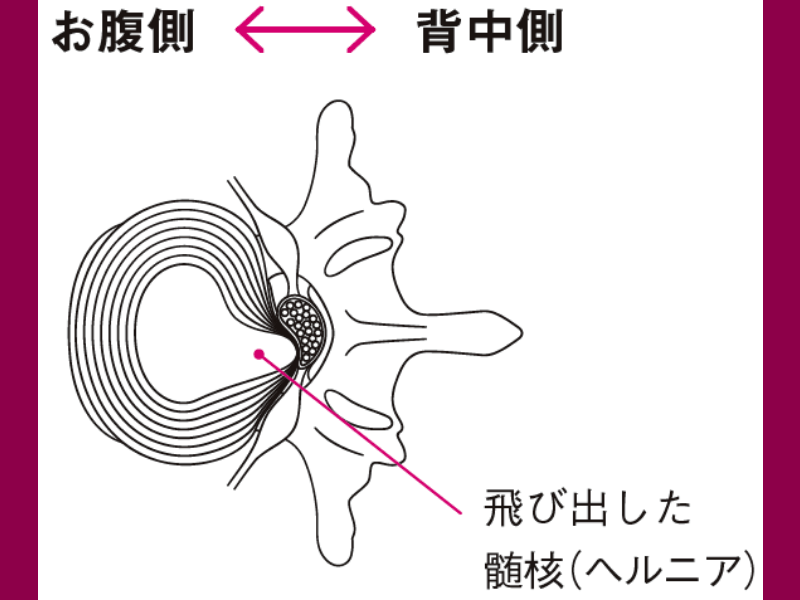 【男性はリスク3倍】20～40代を襲う「腰椎椎間板ヘルニア」の正体とは！？【専門医がしっかり教える 図解 腰痛の話】