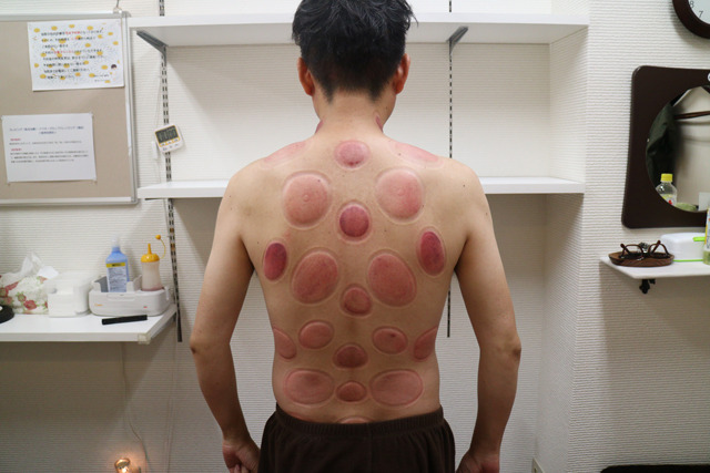 ベッカムやマドンナなどの海外セレブも実践する究極の若返りデトックスを体験してきたの巻 ライブドアニュース