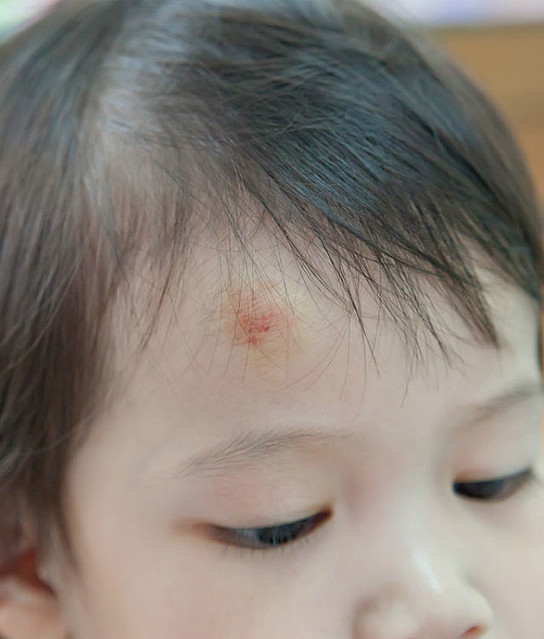 頭部打撲 頭を打ったら何科に行けばいいの ぼくの小児クリニックにようこそ ライブドアニュース