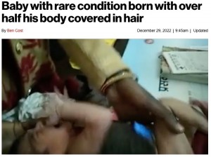 �Τ�60�ѡ�����Ȱʾ夬�����Ӥ�ʤ��줿�������ʲ����ϡ�New York Post��2022ǯ12��29���ա�Baby with rare condition born with over half his body covered in hair�ס�Jam Press Vid/Rare Shot News�ˡ٤Υ����꡼�󥷥�åȡ�