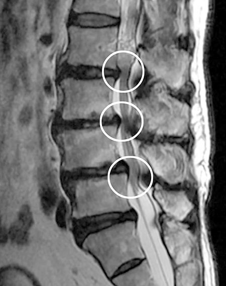 突然脚がガクン、股ぐらには灼熱感…腰痛が脊柱管狭窄症へと悪化した作家
