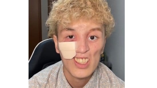 顔に穴が空き、日に日に大きく…希少がんと闘う青年の胸の内、気丈に笑う彼の人生観「僕の人生は僕だけが送っているもの」