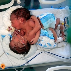 結合 双生児 結合 双生児