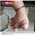 üɤ粽­ʲϡThe Mirror2021ǯ1116աBaby girl born with rare disorder which causes feet to grow unusually largeסImage: Cureusˡ٤Υ꡼󥷥åȡ