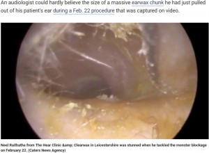 男性の耳の中に大量の耳垢が発見される(画像は『FOX News 2019年6月19日付「Earwax clump clogging entire ear canal removed from patient: ‘Look at that!’」(Caters News Agency)』のスクリーンショット)