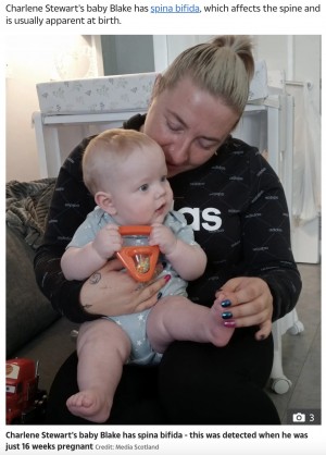 二分脊椎症を持って生まれた男児(画像は『The Sun 2022年10月20日付「MUM’S LOVE My baby boy’s rare condition that means I have to hold him all day long ― and move him every hour at night」(Credit: Media Scotland)』』のスクリーンショット)