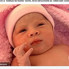 50万人に1人の確率で発生 コロンビアで胎児のお腹にもうひとりの胎児 ライブドアニュース