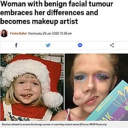 2�ФǴ�˼��礬�Ǥ��Ϥ᤿�����ʲ����ϡ�Metro��2020ǯ1��29���ա�Woman with benign facial tumour embraces her differences and becomes makeup artist�ס�Picture: MDW Features�ˡ٤Υ����꡼�󥷥�åȡ�